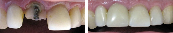 Реставрация фронтального зуба
