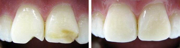 Реставрация фронтального зуба