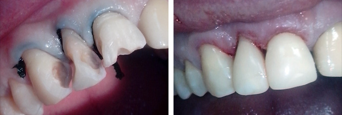 Кариозное поражение зубов верхней челюсти